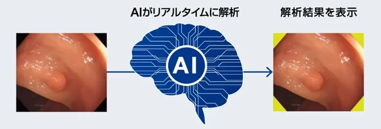 EndoBRAIN-EYE AIがリアルタイムに解析、解析結果を表示